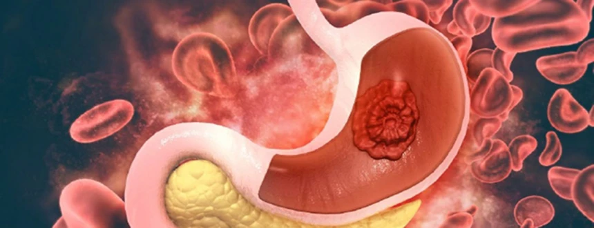 Рак желудка