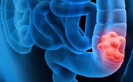 Колоректальный рак — профилактика, стадии, симптомы