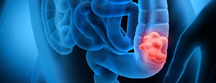 Колоректальный рак — профилактика, стадии, симптомы