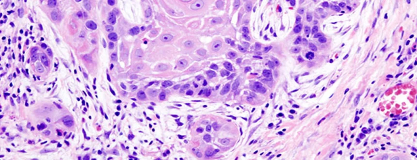 Рак головы и шеи