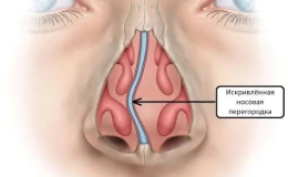 Искривление носовой перегородки