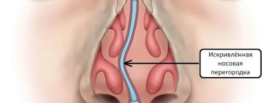 Искривление носовой перегородки