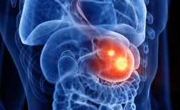 Резекция желудка