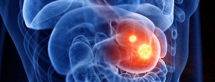 Резекция желудка