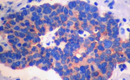 Рак легких немелкоклеточный