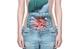 Колостомия